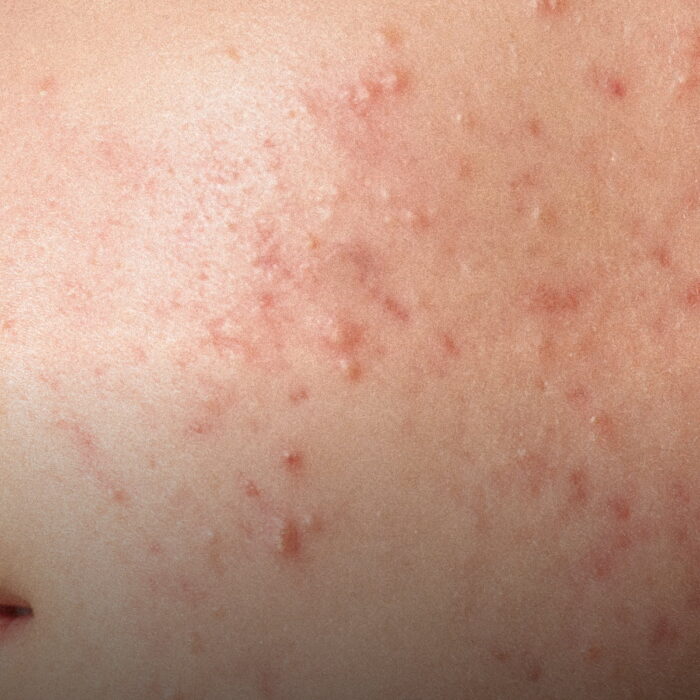 SOS Acne - trattamento urto