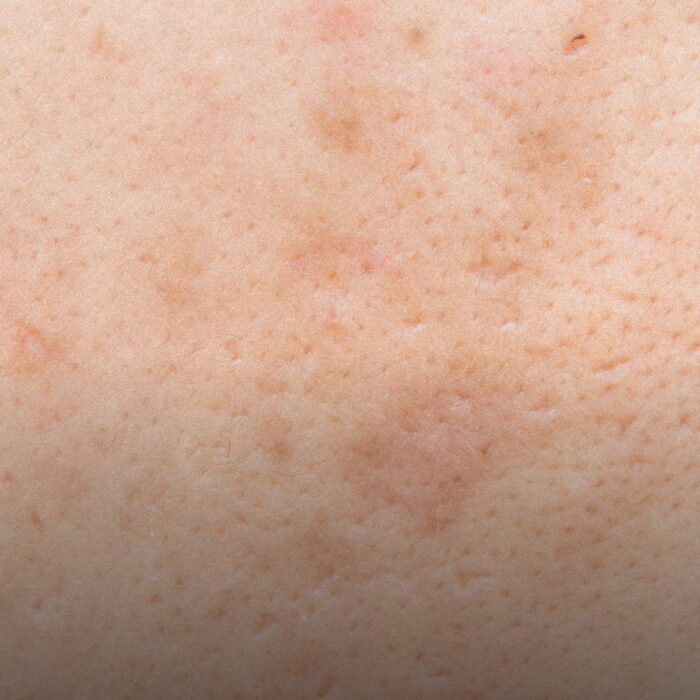 SOS Macchie - trattamento urto